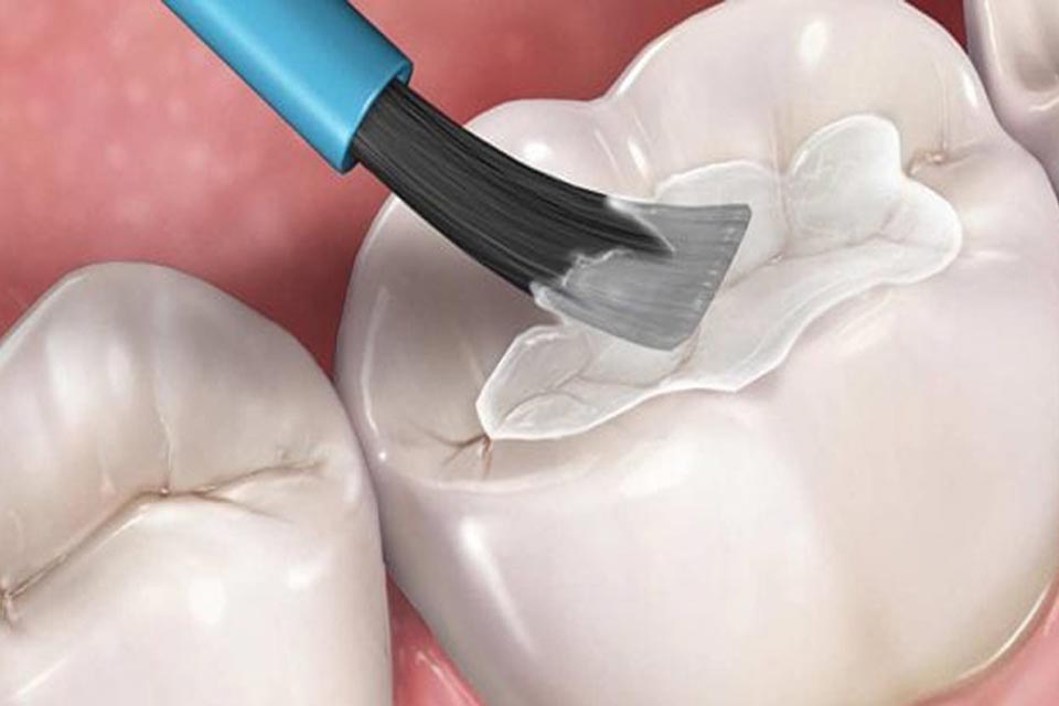 Dental Sealants